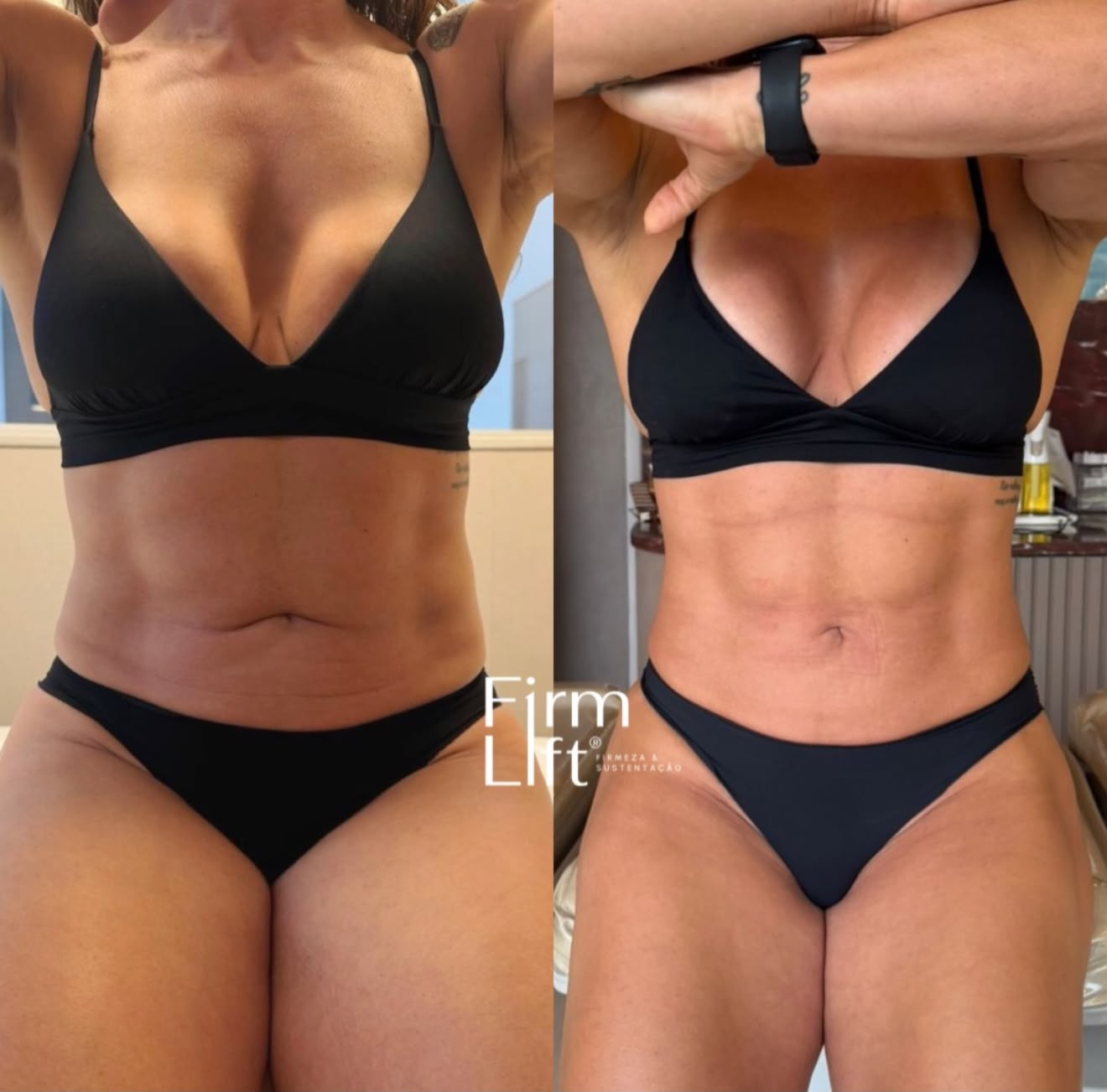Resultado clínico 04, comparação fotográfica lado a lado